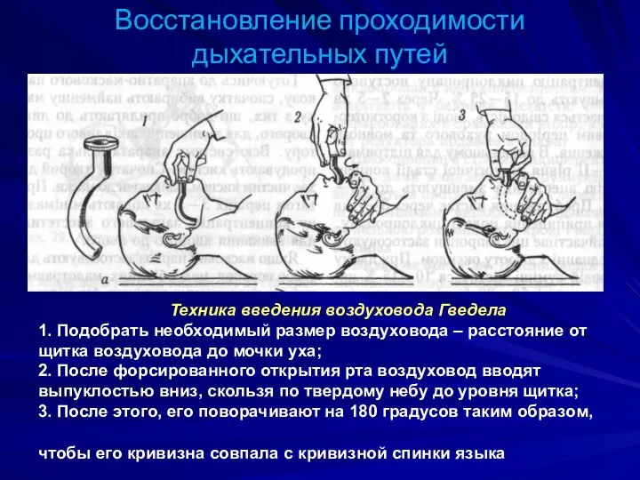 Восстановление проходимости дыхательных путей Техника введения воздуховода Гведела 1. Подобрать необходимый