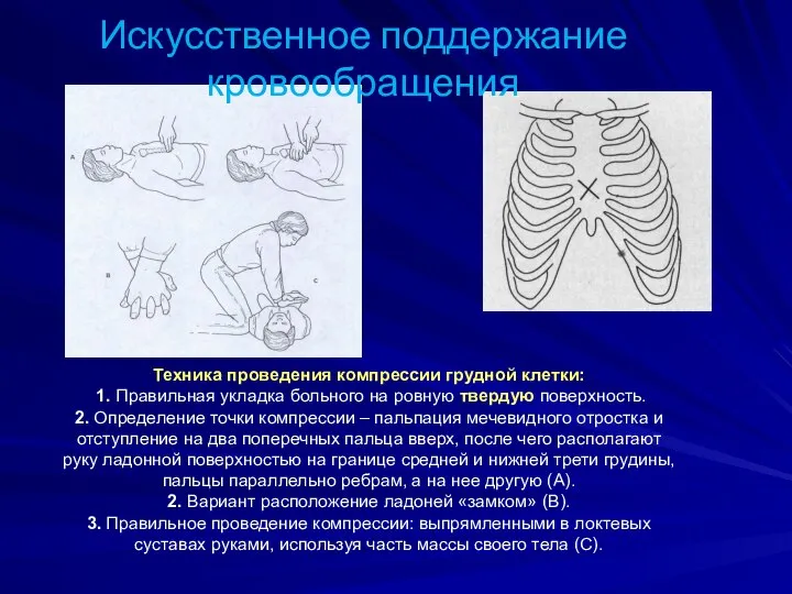 Техника проведения компрессии грудной клетки: 1. Правильная укладка больного на ровную