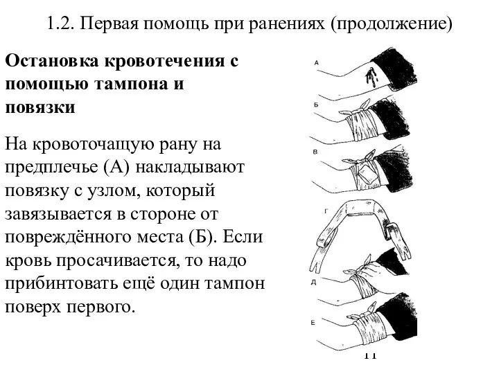 1.2. Первая помощь при ранениях (продолжение) Остановка кровотечения с помощью тампона