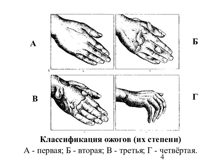 А Б В Г Классификация ожогов (их степени) А - первая;