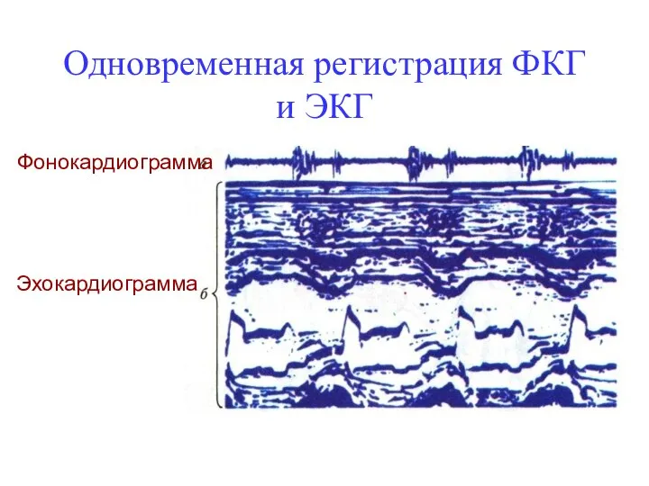 Одновременная регистрация ФКГ и ЭКГ Фонокардиограмма Эхокардиограмма