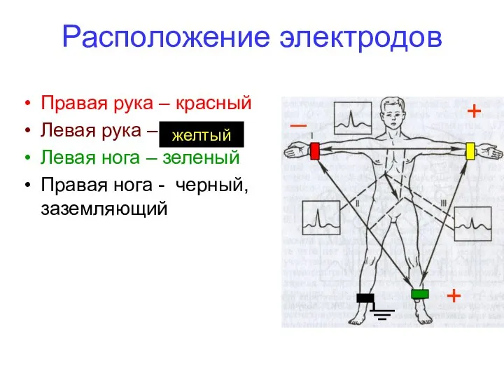 Расположение электродов Правая рука – красный Левая рука – Левая нога