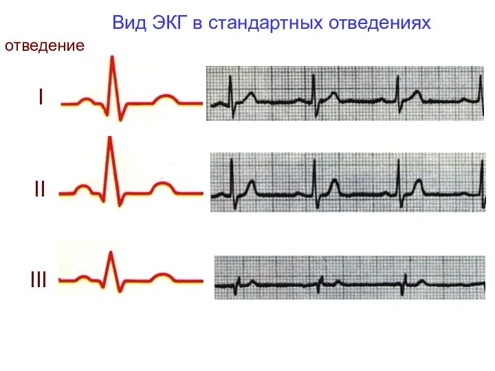 Вид ЭКГ в стандартных отведениях I отведение II III