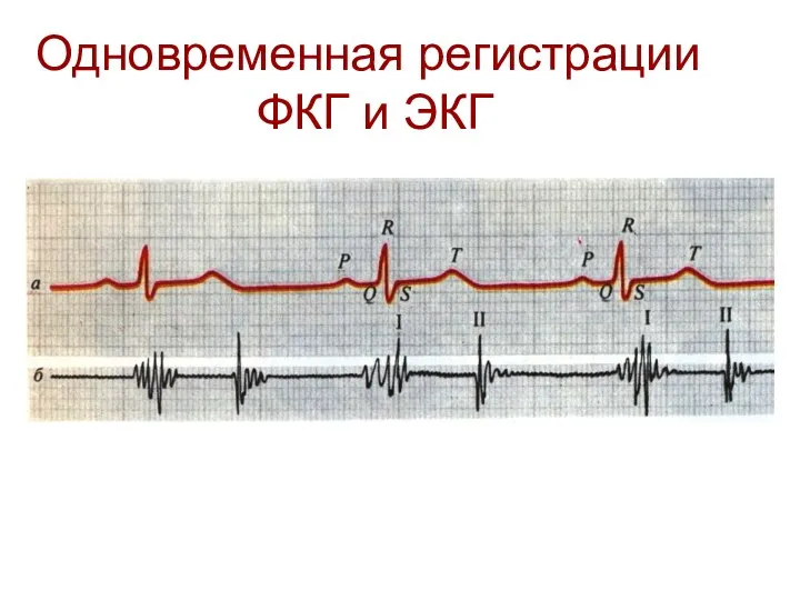 Одновременная регистрации ФКГ и ЭКГ