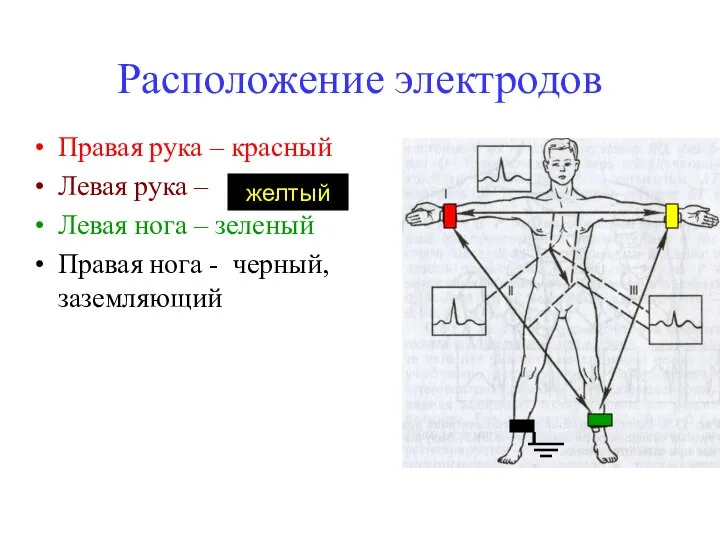Расположение электродов Правая рука – красный Левая рука – Левая нога