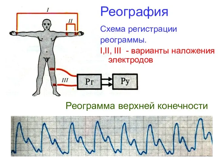 Реография Схема регистрации реограммы. I,II, III - варианты наложения электродов Реограмма верхней конечности