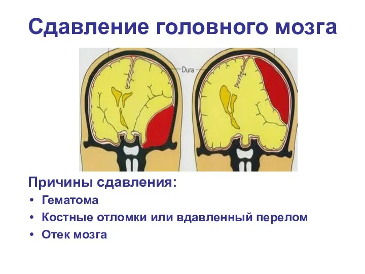 Сдавление головного мозга Причины сдавления: Гематома Костные отломки или вдавленный перелом Отек мозга