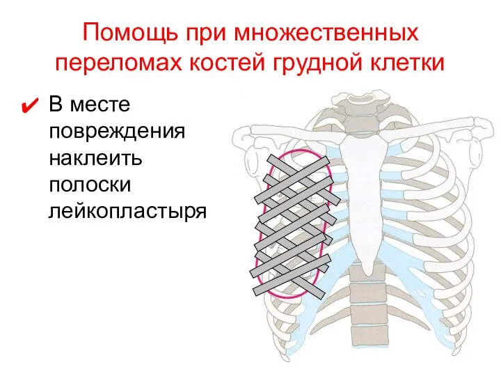 Помощь при множественных переломах костей грудной клетки В месте повреждения наклеить полоски лейкопластыря