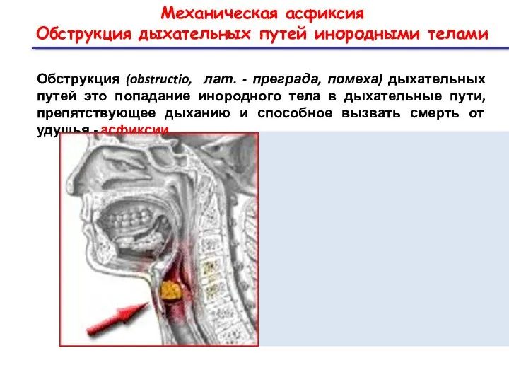 Механическая асфиксия Обструкция дыхательных путей инородными телами Обструкция (obstructio, лат. -