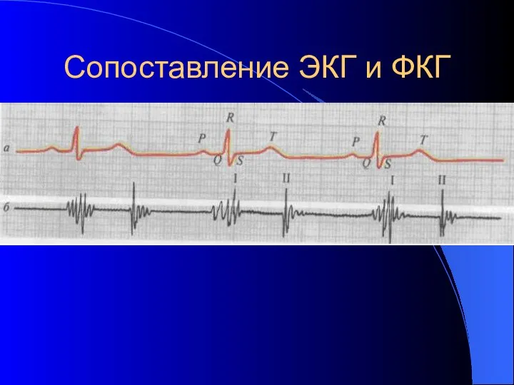 Сопоставление ЭКГ и ФКГ