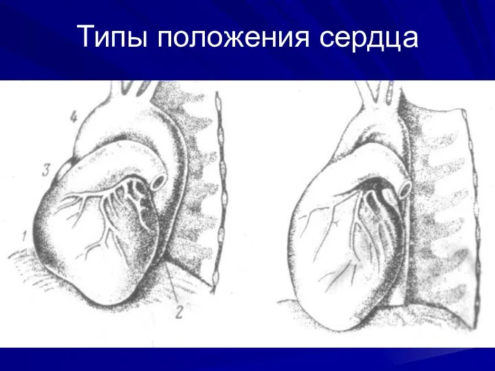 Типы положения сердца