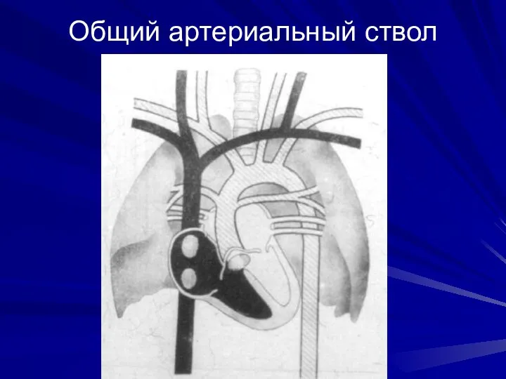 Общий артериальный ствол