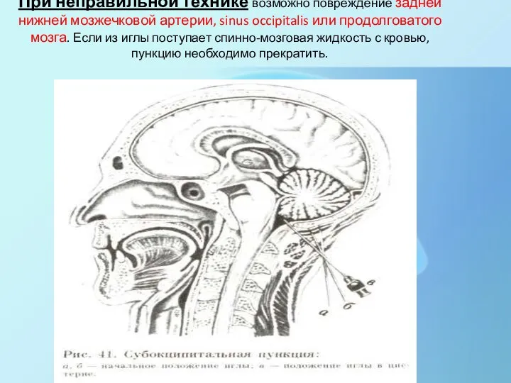 При неправильной технике возможно повреждение задней нижней мозжечковой артерии, sinus occipitalis