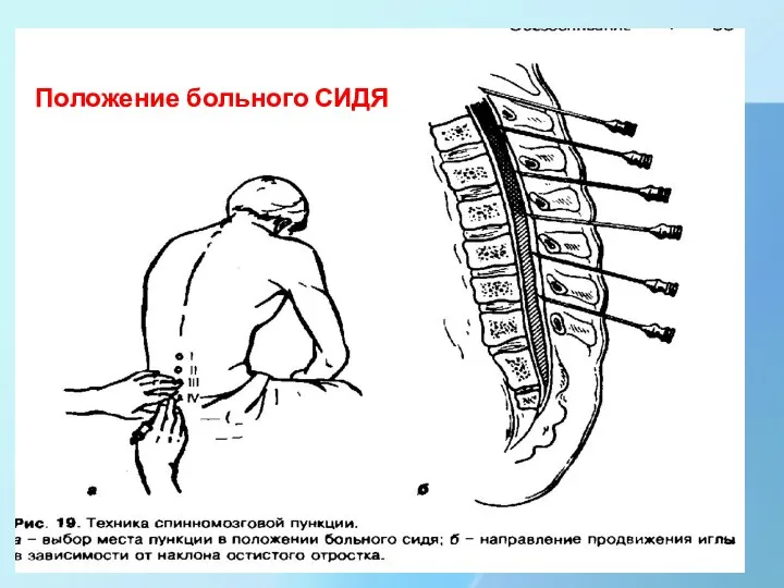 Положение больного СИДЯ