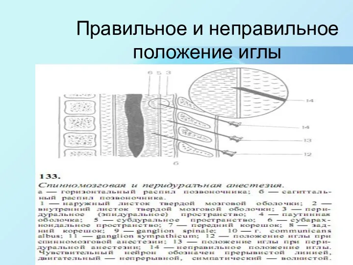 Правильное и неправильное положение иглы