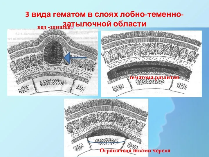 3 вида гематом в слоях лобно-теменно-затылочной области вид «шишки» гематома разлитая Ограничена швами черепа