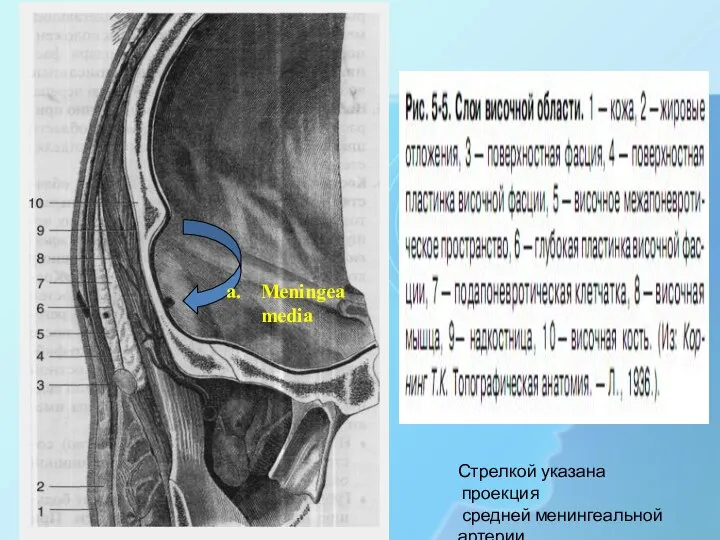 Meningea media Стрелкой указана проекция средней менингеальной артерии