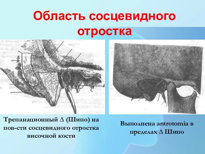 Область сосцевидного отростка Трепанационный ∆ (Шипо) на пов-сти сосцевидного отростка височной