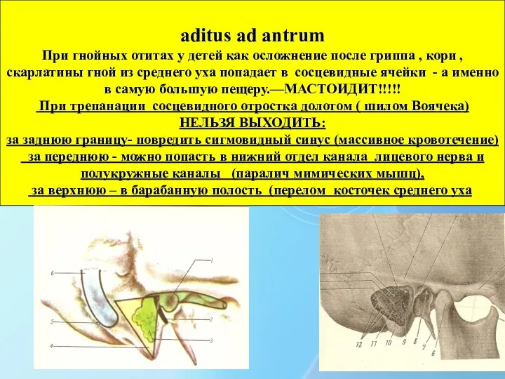 aditus ad antrum При гнойных отитах у детей как осложнение после