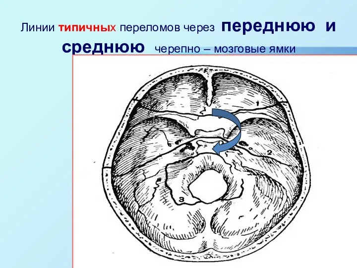 Линии типичных переломов через переднюю и среднюю черепно – мозговые ямки