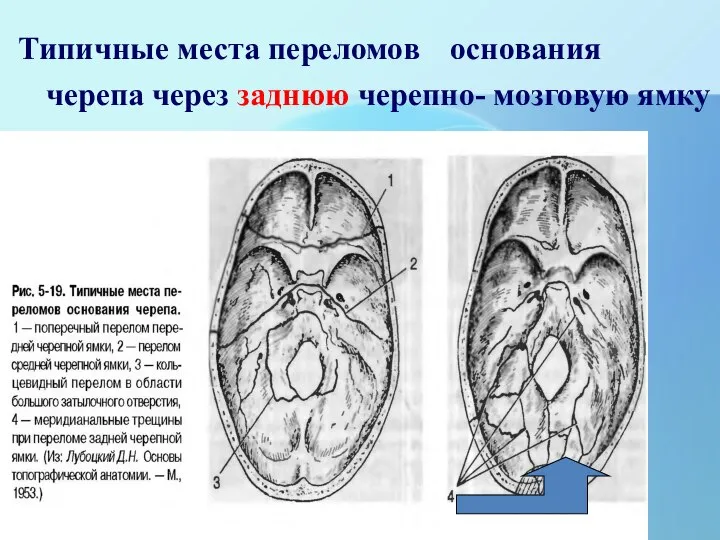 Типичные места переломов основания черепа через заднюю черепно- мозговую ямку