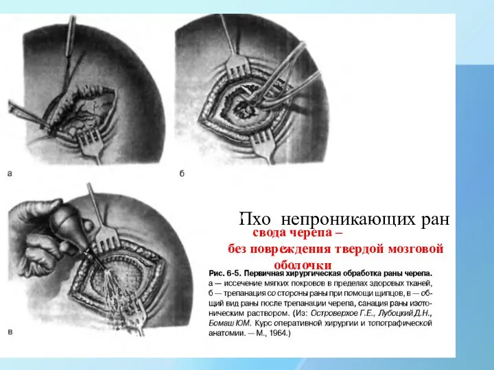 Пхо непроникающих ран Пхо свода черепа – без повреждения твердой мозговой оболочки