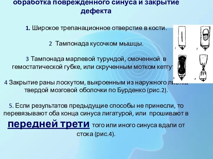 обработка поврежденного синуса и закрытие дефекта 1. Широкое трепанационное отверстие в