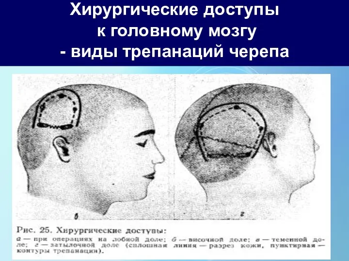 Хирургические доступы к головному мозгу - виды трепанаций черепа