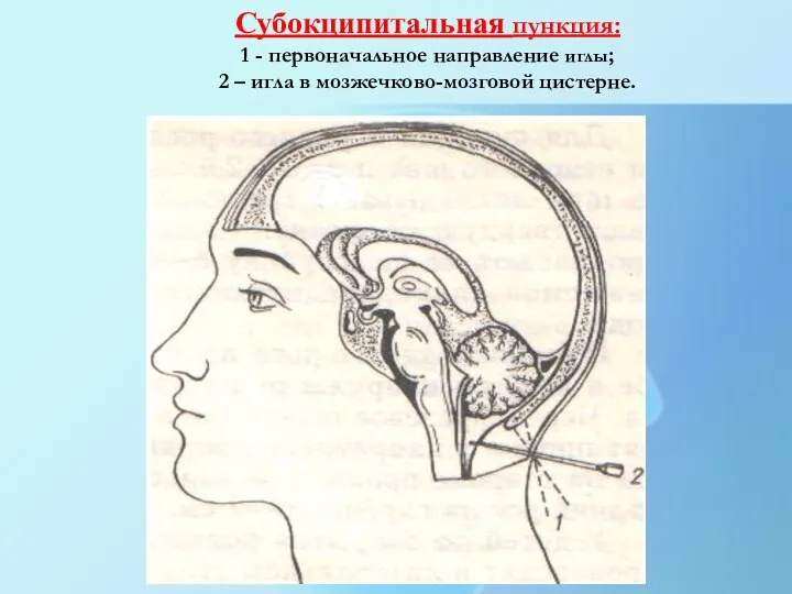 Субокципитальная пункция: 1 - первоначальное направление иглы; 2 – игла в мозжечково-мозговой цистерне.