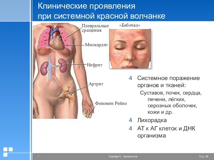 Клинические проявления при системной красной волчанке Системное поражение органов и тканей: