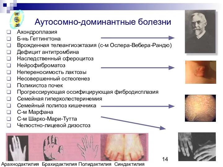 Copyright L. Gerasimova 2007 Ахондроплазия Б-нь Геттингтона Врожденная телеангиоэктазия (с-м Ослера-Вебера-Рандю)