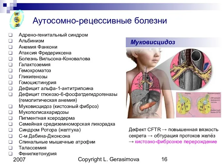 Copyright L. Gerasimova 2007 Аутосомно-рецессивные болезни Адрено-генитальный синдром Альбинизм Анемия Фанкони