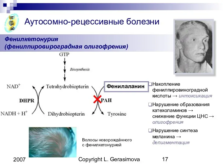 Copyright L. Gerasimova 2007 Фенилкетонурия (фенилпировироградная олигофрения) Аутосомно-рецессивные болезни Фенилаланин Накопление