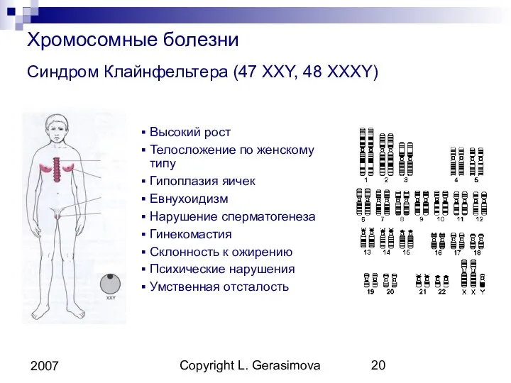 Copyright L. Gerasimova 2007 Хромосомные болезни Синдром Клайнфельтера (47 XXY, 48