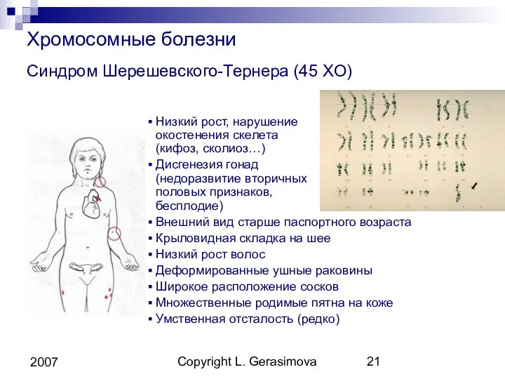 Copyright L. Gerasimova 2007 Хромосомные болезни Синдром Шерешевского-Тернера (45 XO) Низкий