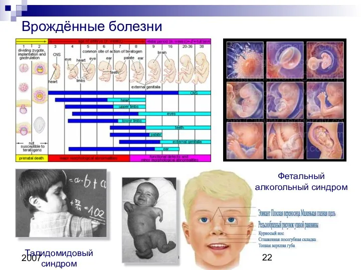 Copyright L. Gerasimova 2007 Врождённые болезни Эпикант Плоская переносица Маленькая глазная