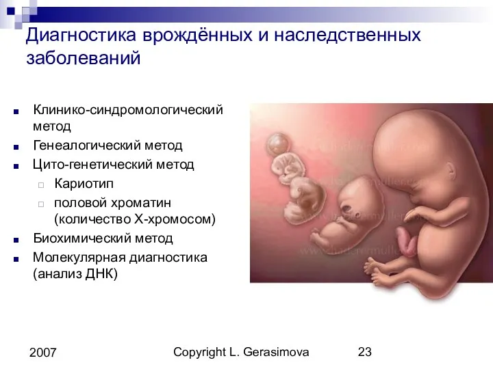 Copyright L. Gerasimova 2007 Диагностика врождённых и наследственных заболеваний Клинико-синдромологический метод