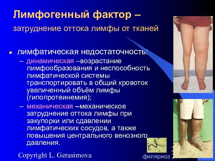 2007 Copyright L. Gerasimova Лимфогенный фактор – затруднение оттока лимфы от