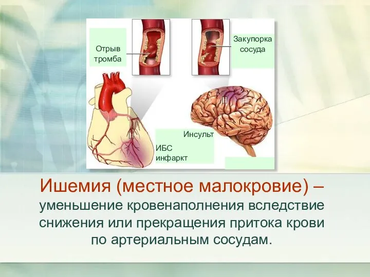 Ишемия (местное малокровие) – уменьшение кровенаполнения вследствие снижения или прекращения притока