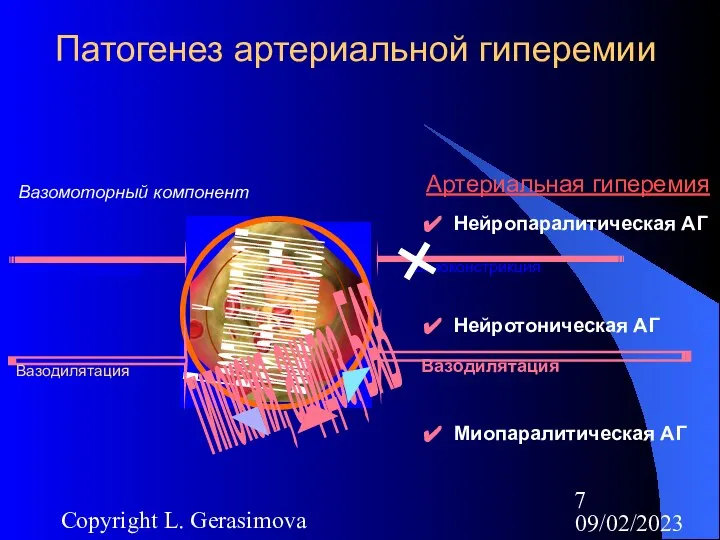 09/02/2023 Copyright L. Gerasimova Патогенез артериальной гиперемии Базальный компонент Вазоконстрикция Вазодилятация