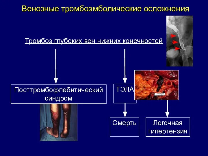 Венозные тромбоэмболические осложнения Тромбоз глубоких вен нижних конечностей Посттромбофлебитический синдром ТЭЛА Смерть Легочная гипертензия