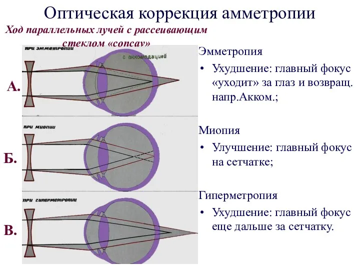 Оптическая коррекция амметропии Эмметропия Ухудшение: главный фокус «уходит» за глаз и