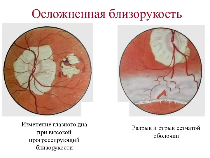 Осложненная близорукость Изменение глазного дна при высокой прогрессирующий близорукости Разрыв и отрыв сетчатой оболочки