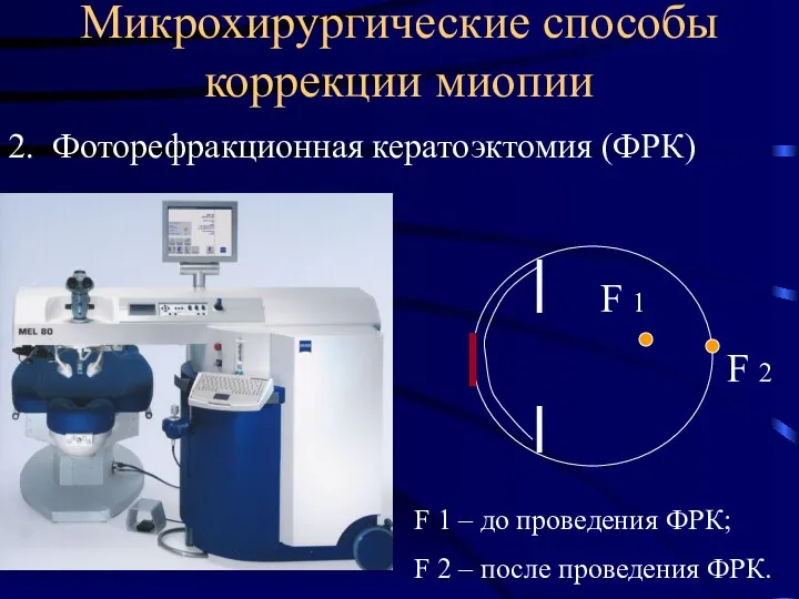 2. Фоторефракционная кератоэктомия (ФРК) Микрохирургические способы коррекции миопии F 1 –