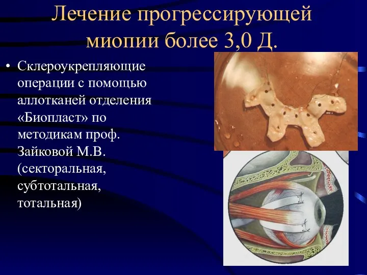 Лечение прогрессирующей миопии более 3,0 Д. Склероукрепляющие операции с помощью аллотканей