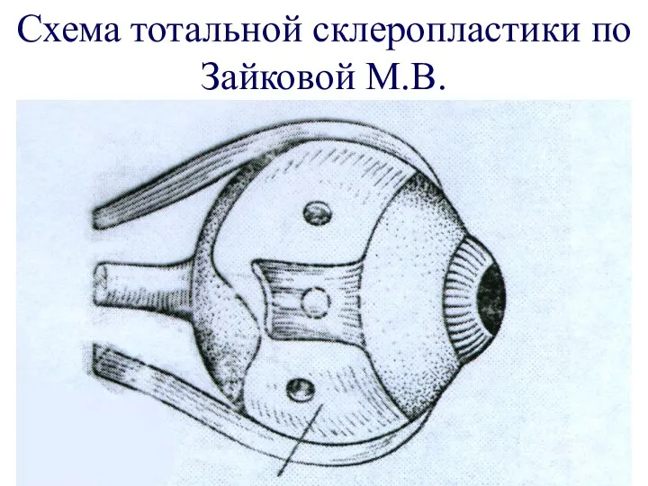 Схема тотальной склеропластики по Зайковой М.В.