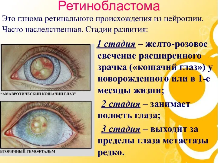 Ретинобластома 1 стадия – желто-розовое свечение расширенного зрачка («кошачий глаз») у