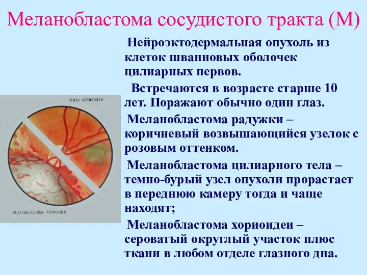 Меланобластома сосудистого тракта (М) Нейроэктодермальная опухоль из клеток шванновых оболочек цилиарных