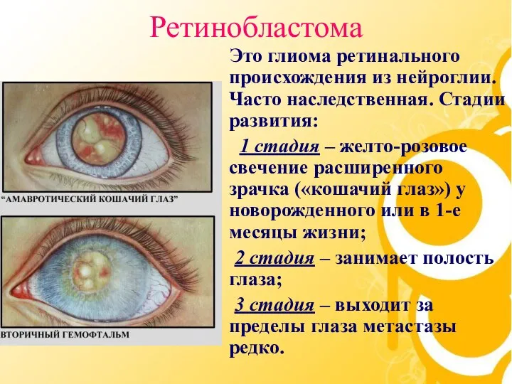 Ретинобластома Это глиома ретинального происхождения из нейроглии. Часто наследственная. Стадии развития: