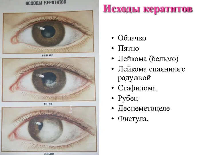 Исходы кератитов Облачко Пятно Лейкома (бельмо) Лейкома спаянная с радужкой Стафилома Рубец Десцеметоцеле Фистула.
